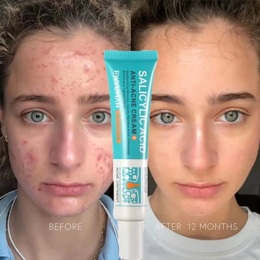 Herbal Acne Removal Face Cream.