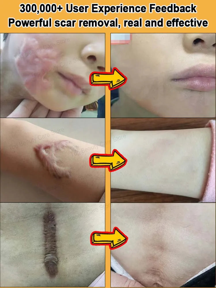 Scar Keloid Laser Removal - BLAKESTORE-NG