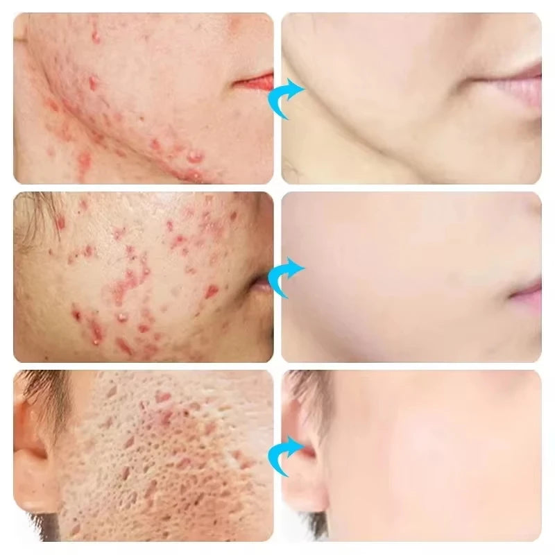 Herbal Acne Removal Face Cream.