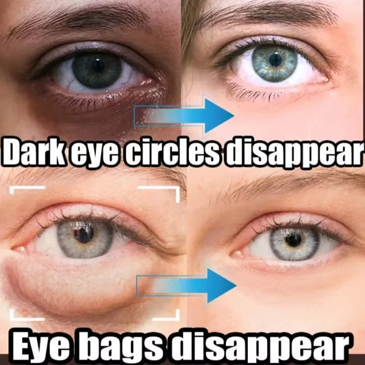 Eye Bag and Dark Circle Removal - BLAKESTORE-NG