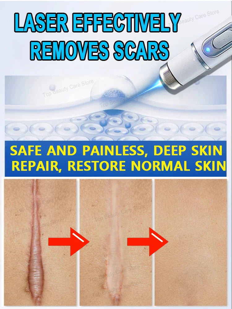 Scar Keloid Laser Removal - BLAKESTORE-NG