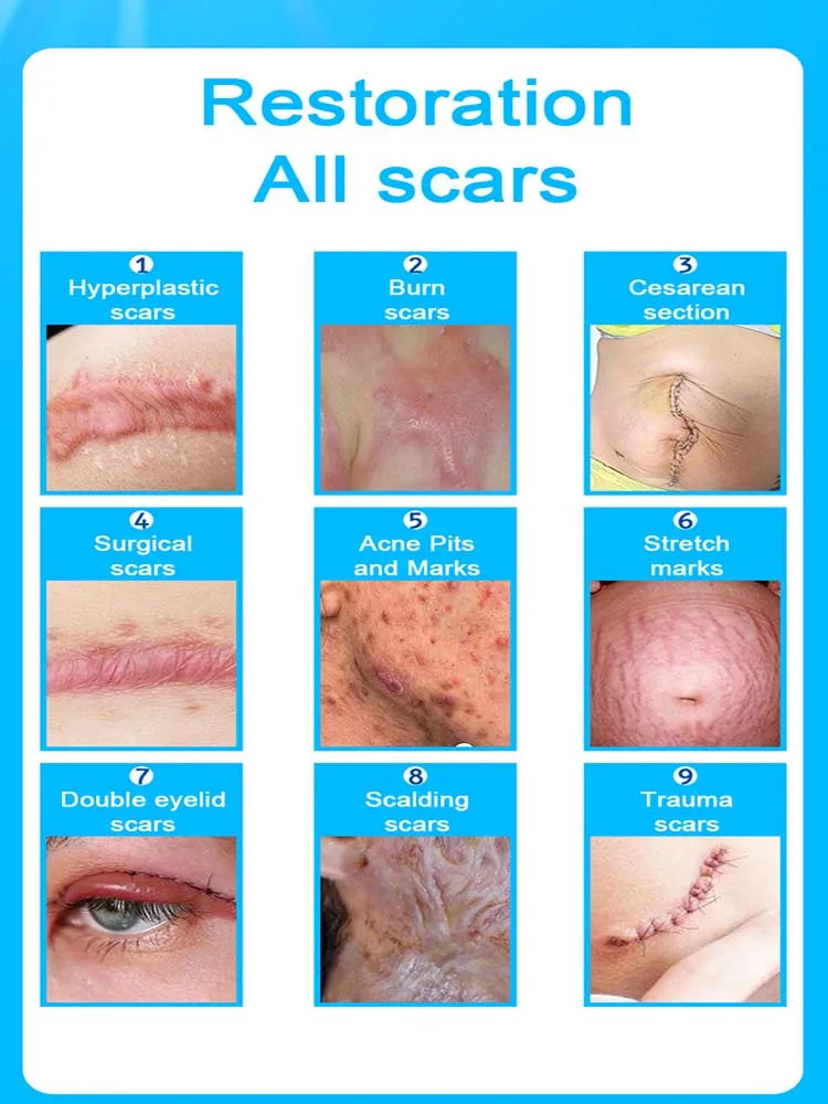 Scar Keloid Laser Removal - BLAKESTORE-NG