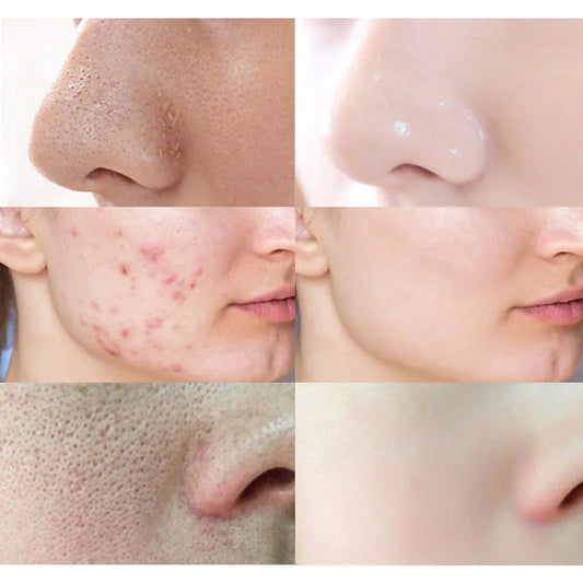 Bubble Mask Face Cleaning for Acne Treatment - BLAKESTORE-NG