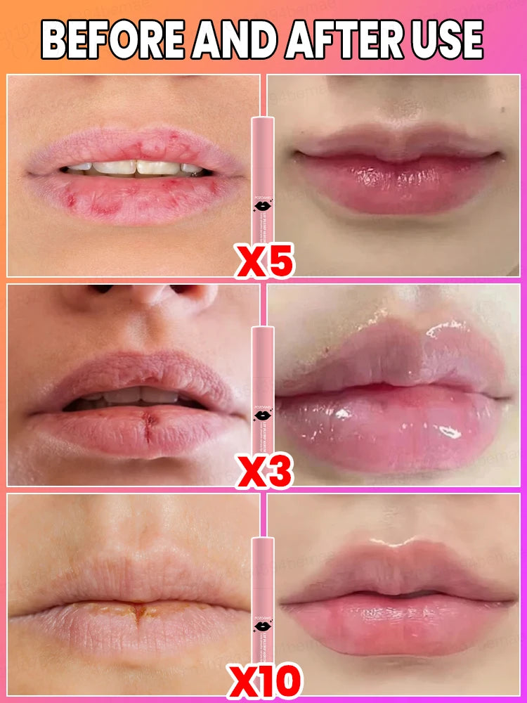 Lip Augmentation in one month.