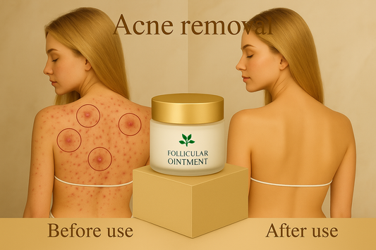 Body Acne Removal Cream | Back, Butt & Face Acne Treatment
