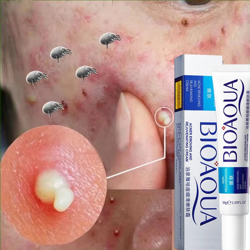 Herbal Acne Removal Face Cream.