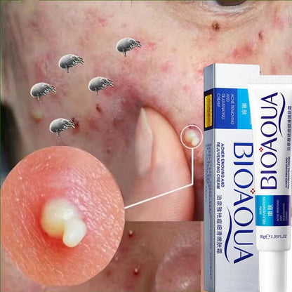 Herbal Acne Removal Face Cream.