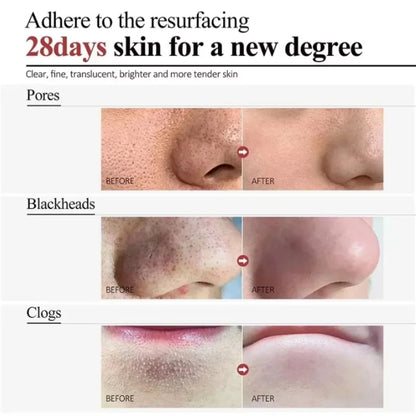 Acne Removal Cream for Men and Women - BLAKESTORE-NG