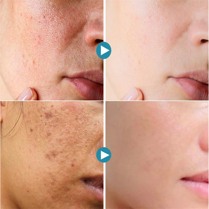 Acne Treatment Anti Aging Serum. - BLAKESTORE-NG