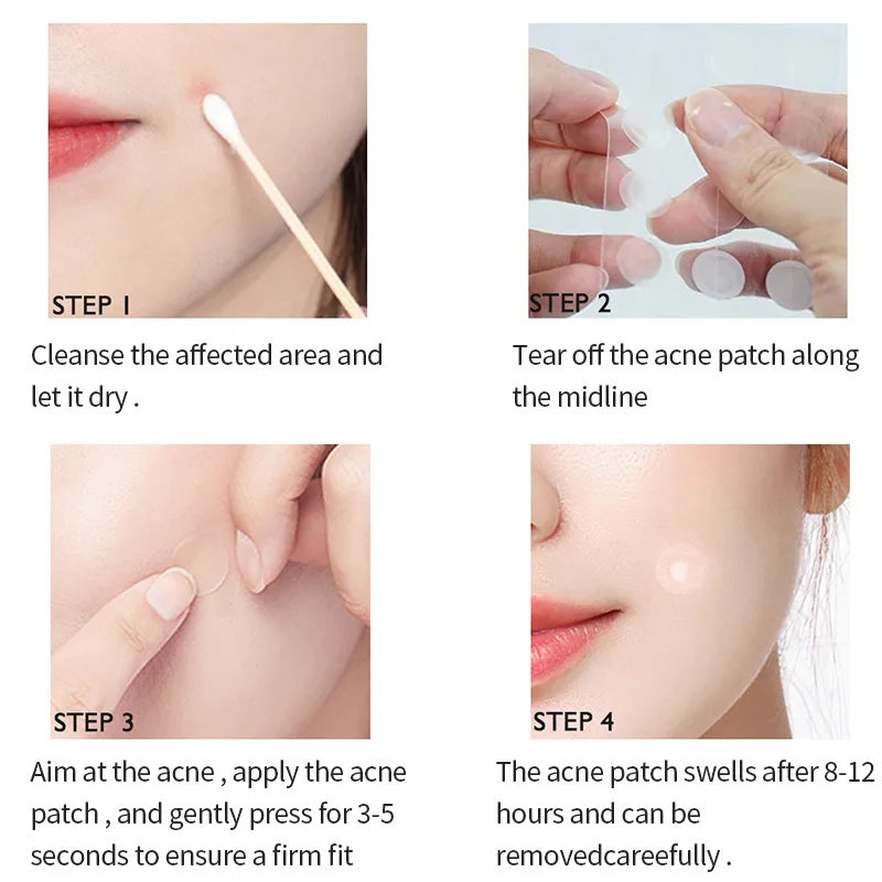 Acne and Pimple Removal And Spots Repair Stickers. - BLAKESTORE-NG
