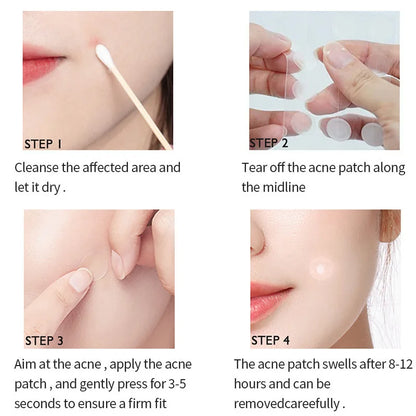 Acne and Pimple Removal And Spots Repair Stickers. - BLAKESTORE-NG