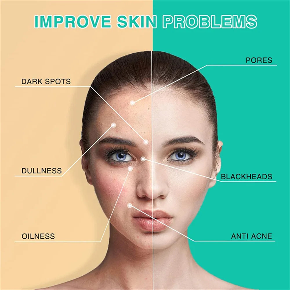 Acne And Blackhead Tumeric Clay Facial Mask. - BLAKESTORE-NG