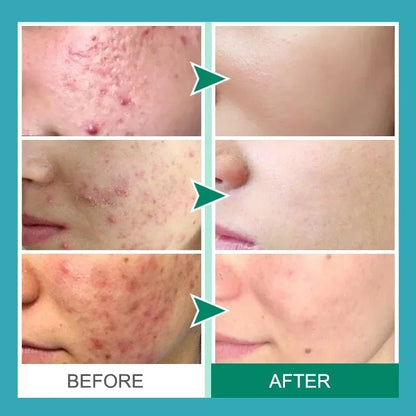 Herbal Acne Removal Face Cream.