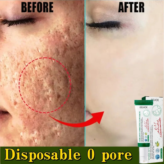 Acne Removal Cream for Men and Women - BLAKESTORE-NG