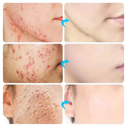 Herbal Acne Removal Face Cream.