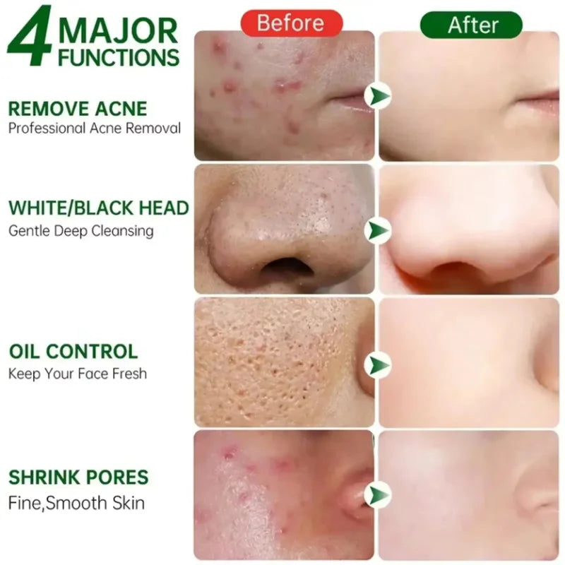Acne Removal Cream for Men and Women - BLAKESTORE-NG