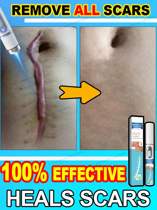 Scar Keloid Laser Removal - BLAKESTORE-NG