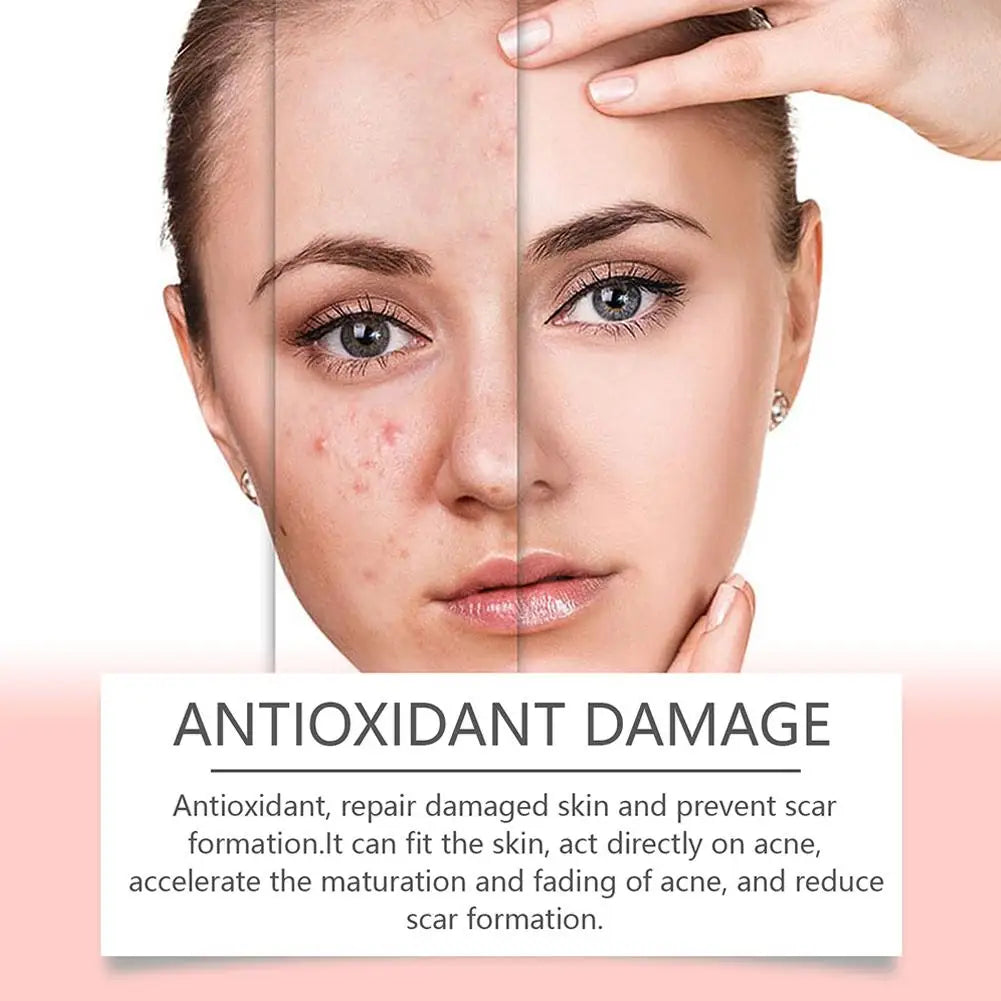 Anti-Acne Waterproof Spot and Marks Concealer - BLAKESTORE-NG