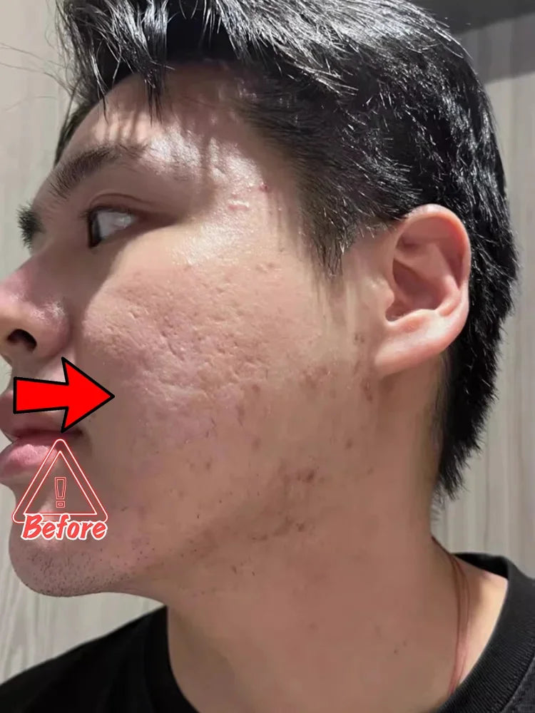 Acne Removal Cream for Men and Women - BLAKESTORE-NG