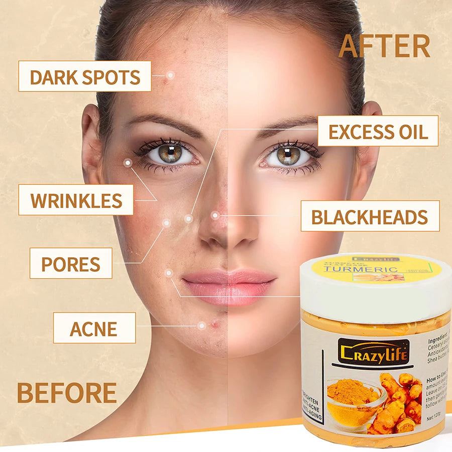 Acne And Blackhead Tumeric Clay Facial Mask. - BLAKESTORE-NG