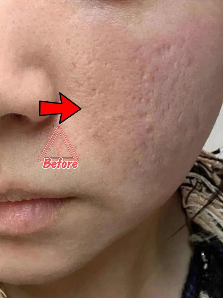 Acne Removal Cream for Men and Women - BLAKESTORE-NG