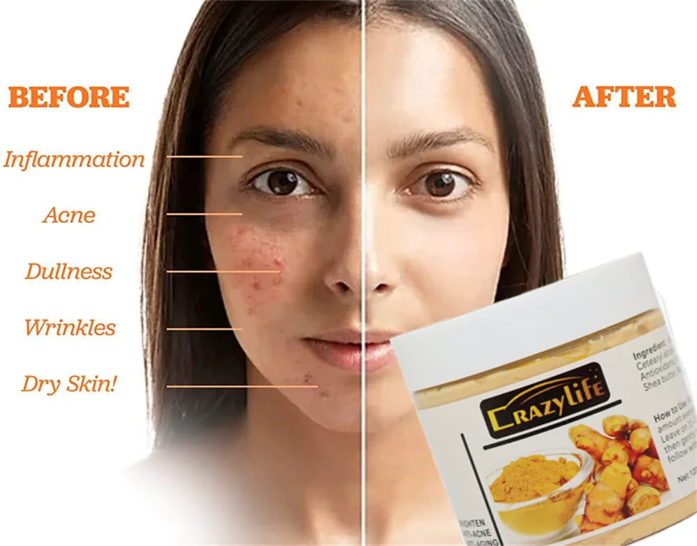 Acne And Blackhead Tumeric Clay Facial Mask. - BLAKESTORE-NG