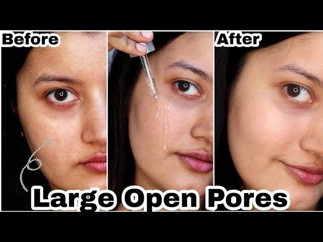 Acne Treatment Anti Aging Serum. - BLAKESTORE-NG