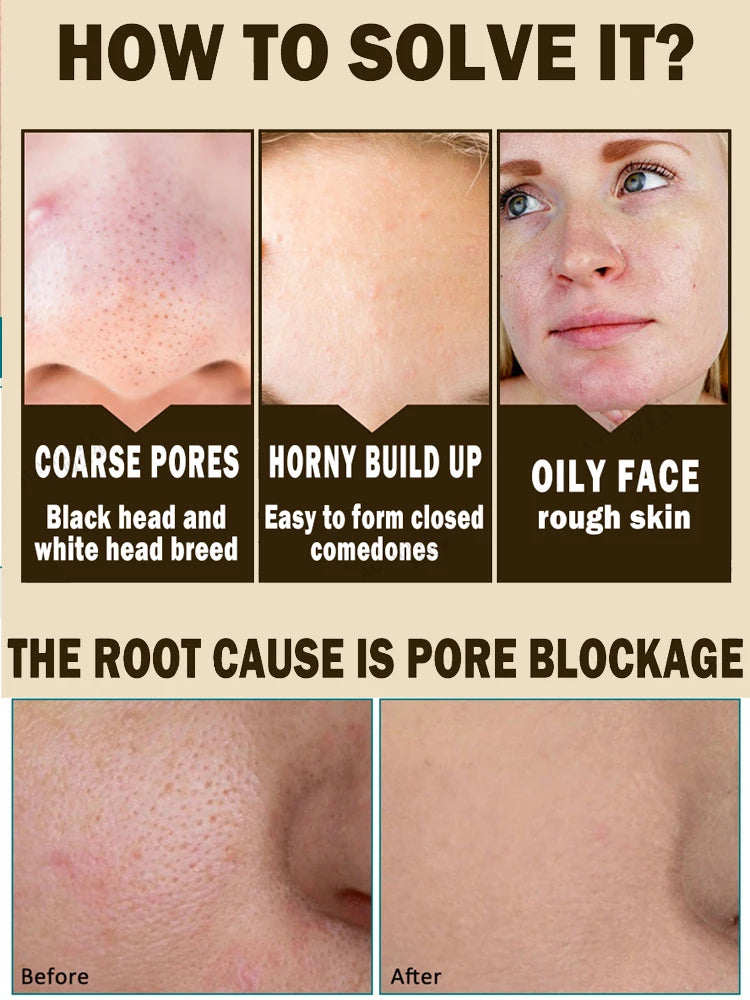 Acne Treatment Anti Aging Serum. - BLAKESTORE-NG