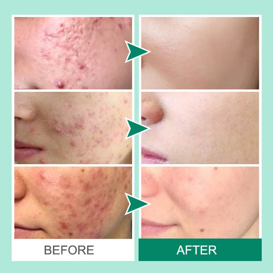 Acne and Blackhead Serum. - BLAKESTORE-NG