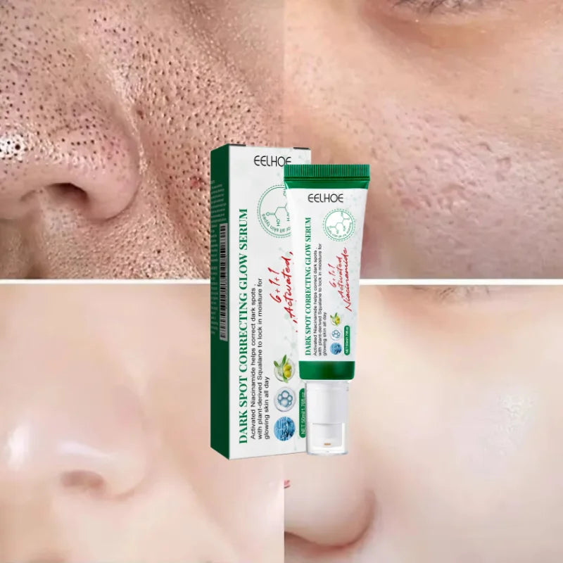 Acne Removal Cream for Men and Women - BLAKESTORE-NG