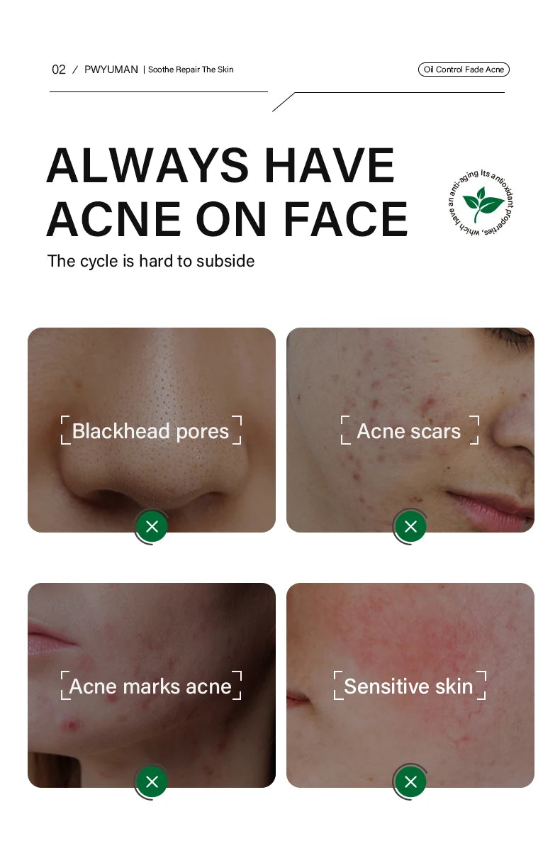 Acne and Blackhead Serum. - BLAKESTORE-NG