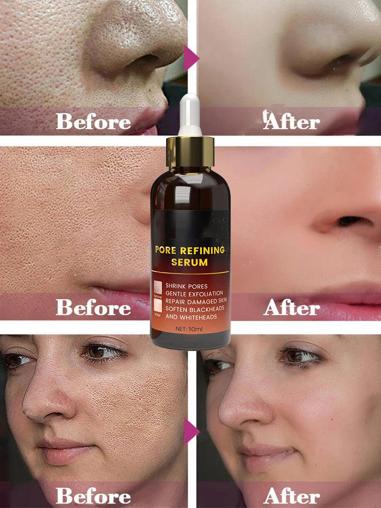 Acne Treatment Anti Aging Serum. - BLAKESTORE-NG