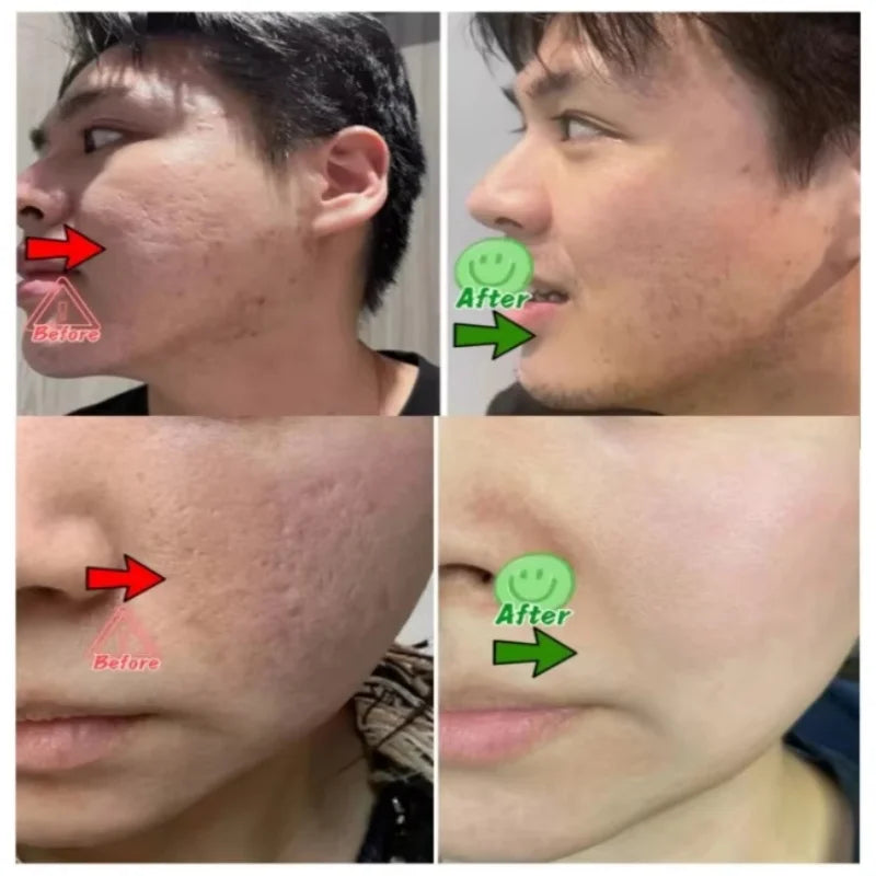 Acne Removal Cream for Men and Women - BLAKESTORE-NG