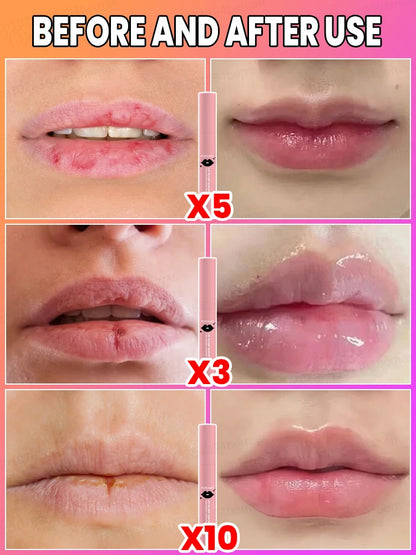 Lip Augmentation in one month.