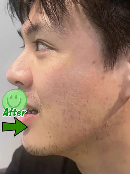 Acne Removal Cream for Men and Women - BLAKESTORE-NG
