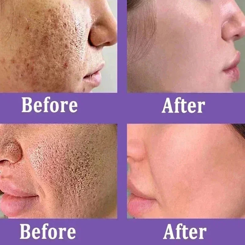 Acne Removal Cream for Men and Women - BLAKESTORE-NG