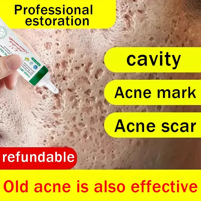 Acne Removal Cream for Men and Women - BLAKESTORE-NG