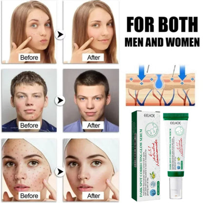 Acne Removal Cream for Men and Women - BLAKESTORE-NG