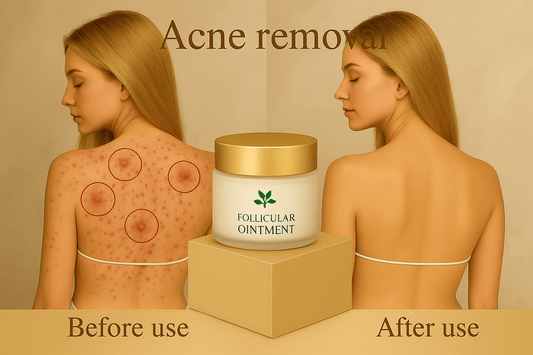 BLAKESTORE-NG Acne Remover cream Body Acne Removal Cream | Back, Butt & Face Acne Treatment