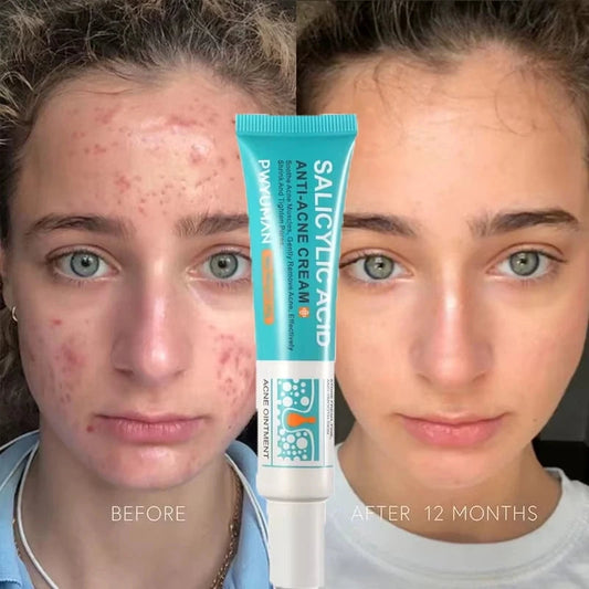 BLAKESTORE-NG Acne Remover cream Herbal Acne Removal Face Cream.